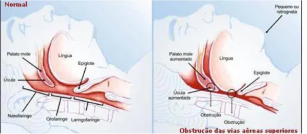 Figura 2: Obstrução das vias aéreas superiores por retrognatismo e alterações estruturais da faringe