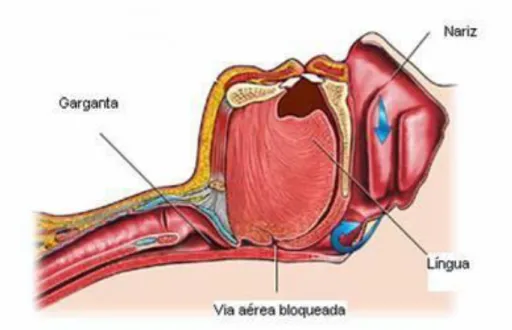 Figura 3: Oclusão total da faringe na apneia obstrutiva. (Adaptado de: Carvalho, 2008)