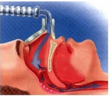 Figura 5:  Manutenção da permeabilidade das vias aéreas através da utilização de CPAP