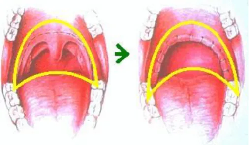 Figura 6: Uvopalatofaringoplastia. (Adaptado de: Carvalho, 2008). 