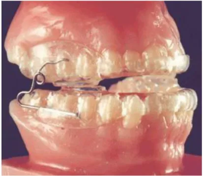 Figura 9: Aparelho de avanço mandibular. (Adaptado de: Carvalho, 2008). 