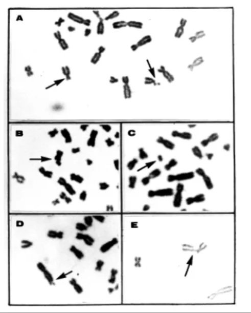 Figura - Metáfases parciais provenientes de linfócitos cultivados apresentando: (A) quebra cromatídica no braço curto de um cromossomo do grupo C e um cromossomo do grupo D com o braço curto aumentado, do indivíduo E2; (B) quebra cromatídica na posição med