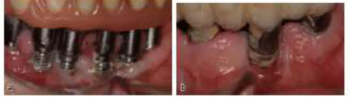 Figura 6 Fotografia clínica dos sítios de implantes na mandíbula de um homem de 75  anos (a) e de uma mulher de 62 anos (b)