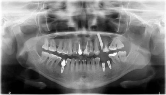 Figura 7: radiografia panorâmica após seis meses da colocação dos implantes 35 e 36. 