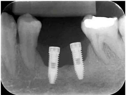 Figura 8: Radiografia periapical seis meses após a colocação dos implantes,  confirmando a perda óssea na altura do terço médio das fixações