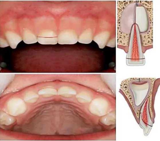 Figura  12  –   Fractura  corono-radicular  com  exposição  pulpar.  (Adaptado  da  sociedad  Española de Odontopediatría)