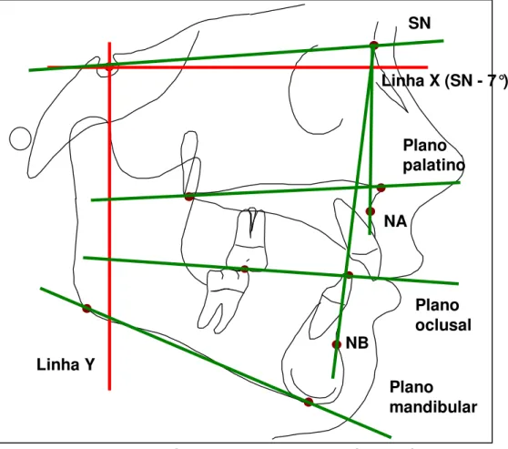 FIGURA 3 - Linhas e Planos Cefalométricos SN  Linha X (SN - 7°) Plano palatino Plano oclusal Plano mandibular NA NB Linha Y 