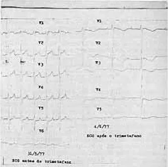 Fig. 2 - Pacientes C.P.S. Ritmo sinusal e sobrecarga de câmaras esquerdas. Notar grandes ondas U de V