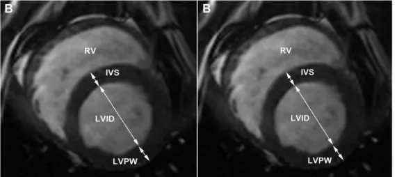 Figure  6:  Short  axis  view  of  the  left  ventricle:  end  diastolic  (left)  and  end  systolic  (right) 3 