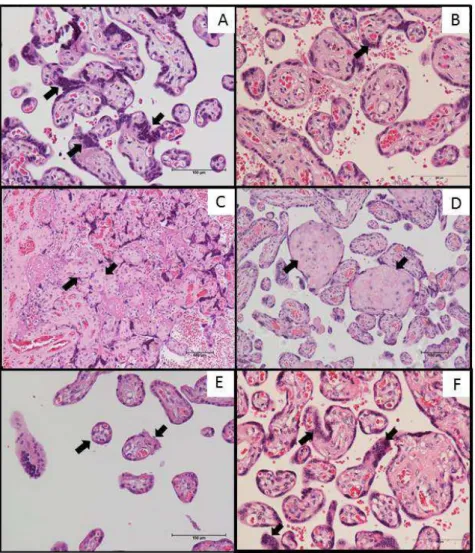 Figura  1.  Fotomicrografia  representativa  da  histopatologia  placentária  de  gestantes  normotensas e portadoras de PE