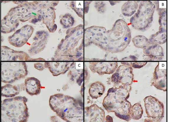 Figura  1 .  Fotomicrografia  representativa  da  expressão  de  citocinas  em  cortes  de  placenta de gestantes portadoras de PE