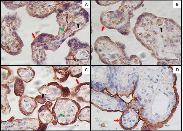 Figura  2.  Fotomicrografia  representativa  da  expressão  de  fatores  angiogênicos  em  cortes de placenta com 37 semanas de gestantes portadoras de PE