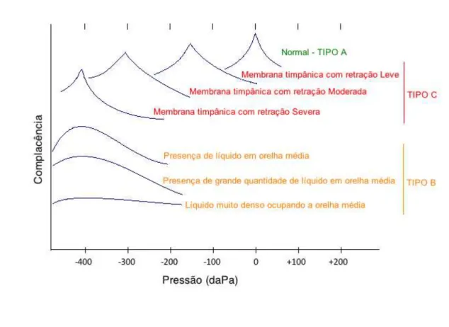 Figura 1 - Diagrama esquemático mostrando os tipos de curvas timpanométricas 