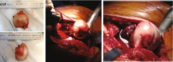 Figure 3: Femoral head fragment and its rigid ﬁ xation with 3 subchondral cannulated screws.