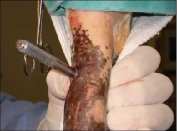 Figura  2:  Excisão  de  fragmento  de  ligamento  suspensório  por meio de punch para biópsia 