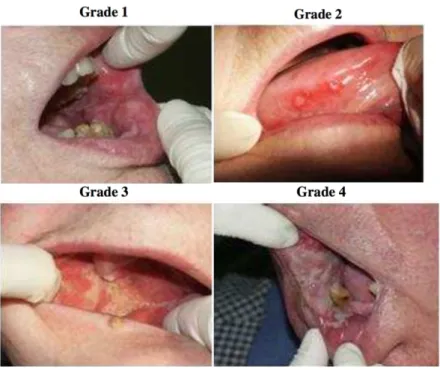 Figura 4: Avaliação clínica do grau das mucosites (Collangettes, Berger, Jadaud &amp; Tequi., 2011) 