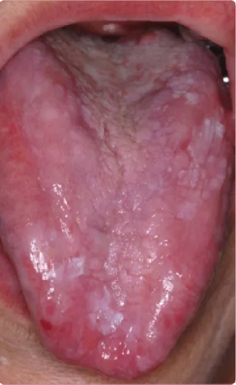 Figura 10 - Aparência atrófica da mucosa dorsal da língua devido à infecção por LP (GHEORGHEa &amp; 