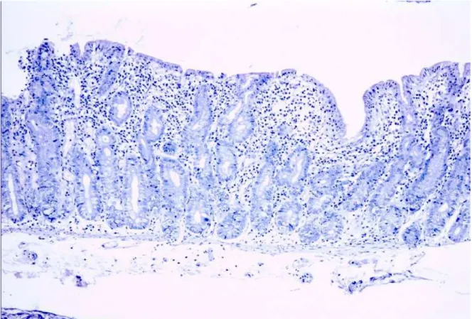 FIGURA 2 – Biópsia intestinal considerada padrão celíaco, hipotrofia grau IV,  coloração hematoxilina-eosina, aumento 400 vezes