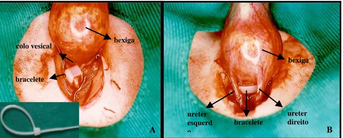 Figura 4: A - visão anterior da região do colo vesical com bracelete e no  quadrante inferior esquerdo o detalhe do bracelete e B - visão posterior  demonstrando a posição adequada dos ureteres em relação ao bracelete