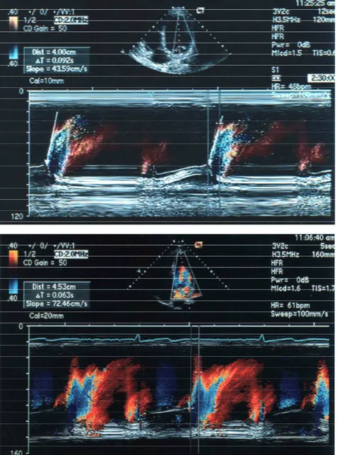 Figura  4  -  Exemplo  do  registro  da  velocidade  de  propagação  do  fluxo  mitral  ao  modo-M  em  cores  (VPM)  de  um  paciente  (VPM  =  43,59  cm/s)  (acima) e de um controle (VPM = 72,46 cm/s) (abaixo)