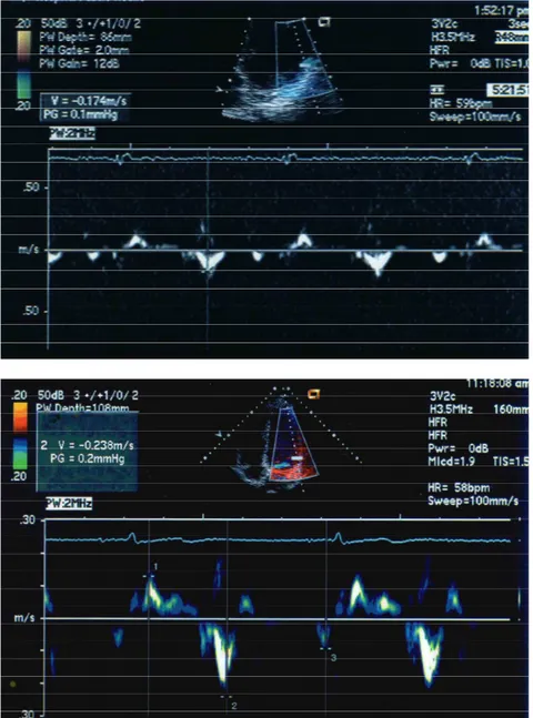 Figura 6 - Exemplo do registro ao Doppler tecidual pulsado, eixo apical 4  câmaras, da onda de velocidade diastólica inicial, na parede ântero-lateral,  segmento  basal  (EmBasLat)  de  um  paciente    (Em  =  17,4cm/s)    (acima)  e  um controle (Em = 23,