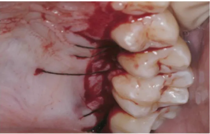 Figure 7. The autologous bone graft harvested from maxillary tuberos- tuberos-ity by using a roungeur .