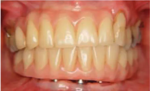 Figure 9: Clinical aspect of the prosthesis after 12 months.