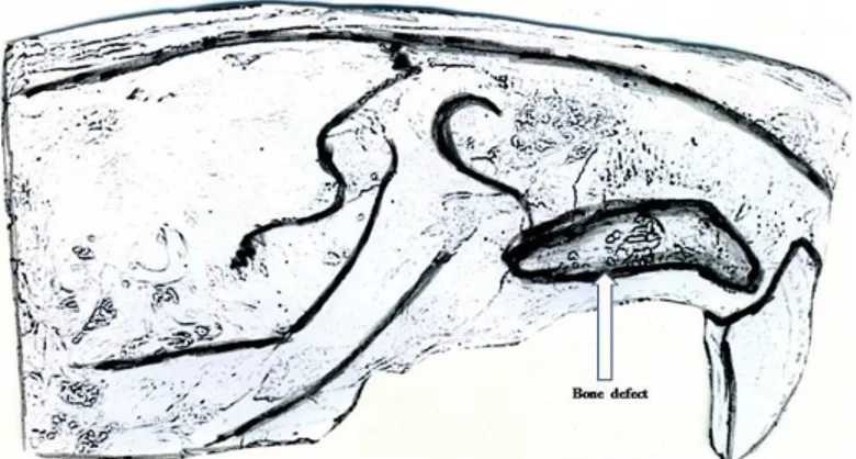 FIGURE 2 - Illustration of the bone defect compromising the maxillary and alveolar regions