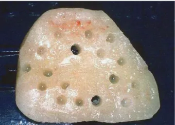 Figure 1. Receptor site before reconstruction. Figure 3. Nonperforated grafts fixed to the host bed.Figure 2