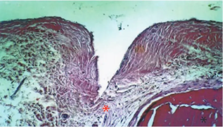 Figure 4. On the inner side of the nonperforated bone graft, observations of  immature bone, large trabecular spaces, and some areas of newly formed bone  is possible (H&amp;E,  × 250)