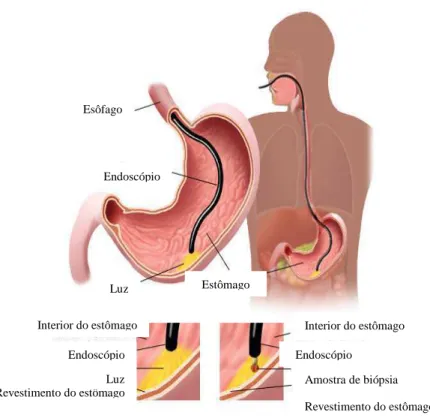 FIGURA 1 - Procedimento de esofagastroduodenoscopia (EGD) ou endoscopia digestiva alta (EDA)