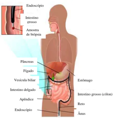 FIGURA 2 - Procedimento de colonoscopia ou endoscopia digestiva baixa (EDB).  