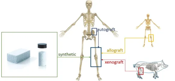 Figure 2.4 - Various types of bone graft sources. 