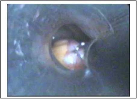 FIGURA 3 – Exteriorização do apêndice vermiforme pelo trocarte  umbilical. 