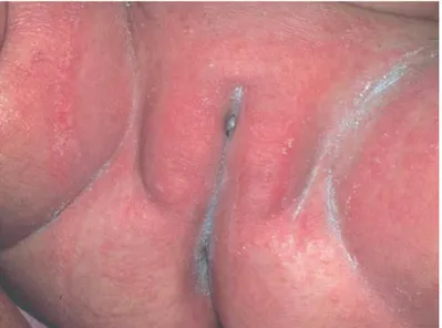 Figura  3:  Dermatite  da  área  das  fraldas  irritativa  primária.  Lesões  eritmâto-descamativas,  edematosas na região da fralda, poupando pregas (imagem retirada de Fernandes, 2009)