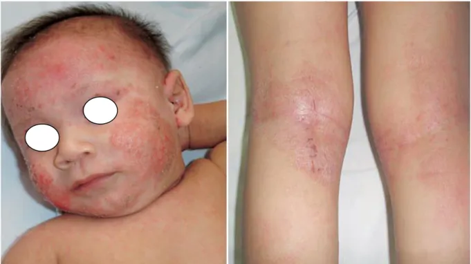 Figura 7 e 8: Dermatite atópica em recém-nascido e criança, afectando a cara e as zonas flexo- flexo-ras, respectivamente (Chambergo, 2008)