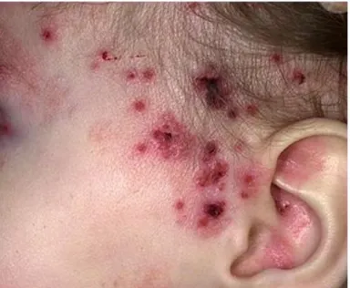 Figura  9:  Eczema  herpético  atingindo  região  lateral  da  face  e  ouvido  (imagem  adaptada  de  www.iqb.es/)