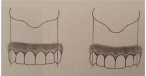 Figura 9 - Correspondência entre a largura da base  do  nariz  e  a  distância  entre  as  cúspides  caninas  (Adaptado de Mondelli, 2003)