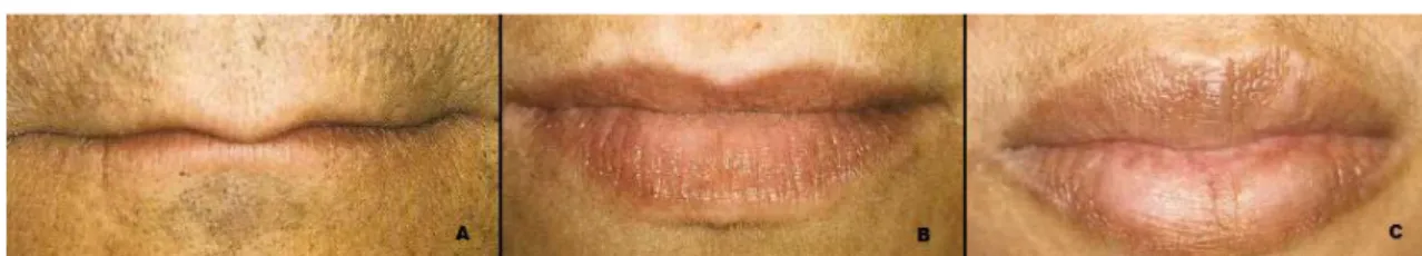 Figura  16  –   Lábios  finos  (A),  lábios  médios  (B)  e  lábios  grossos  (C)  (Adaptado  de  Fradeani, 2004).