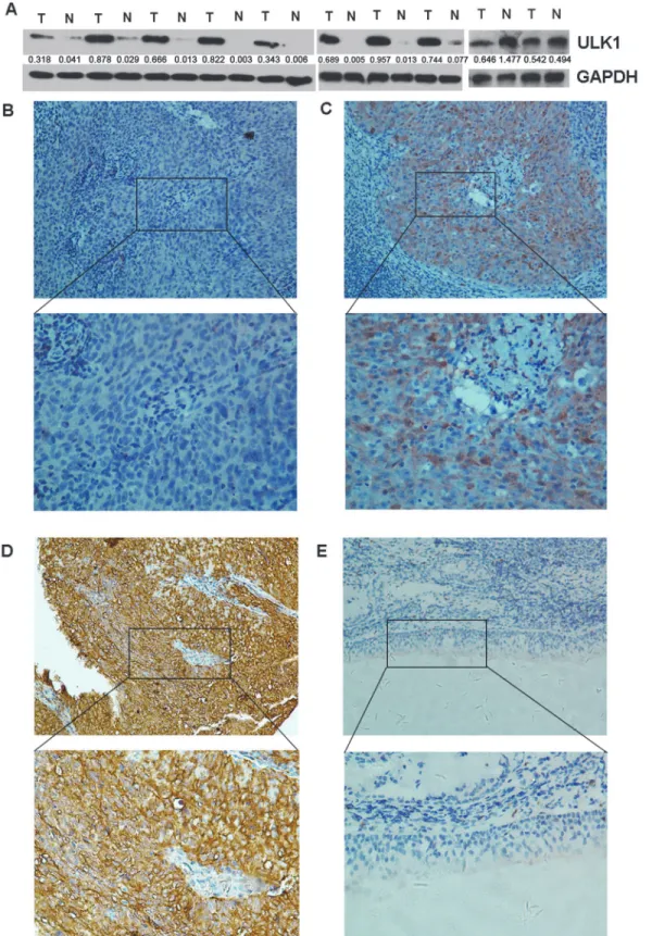 Fig 1. The expression of ULK1 in NPC tissues. (A) Western blot analysis of ULK1 protein expression in 10 representative paired of NPC (T) and adjacent normal mucosa tissues (N)