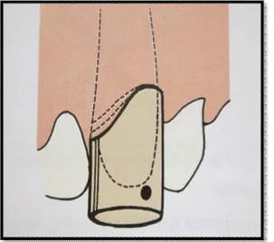 Figura 5  –  O tubo é cheio com material de impressão  e é assente cuidadosamente no local acompanhando  o longo eixo de inserção do dente preparado