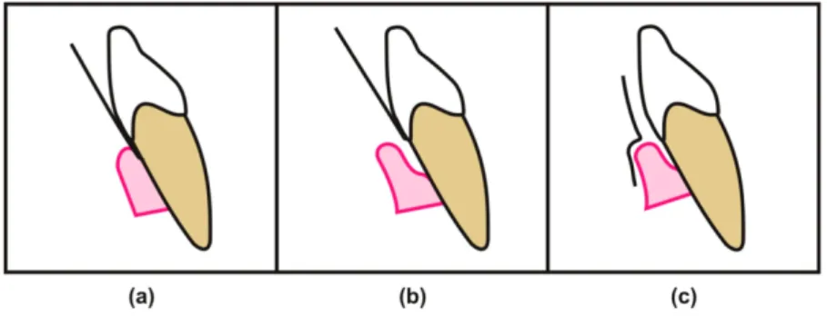 Figura  2  :  Representação  das  diversas  abordagens  para  a  recolha  de  fluído  crevicular