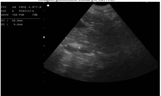 Figura 6- Quisto paraprostáticos dorsal à prostata em animal do grupo alvo (D1: 28,8mm; D2: 4,6mm)  (imagem gentilmente cedida por HRVM)