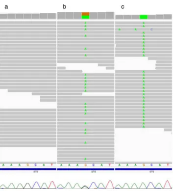 Fig. 5. Determining phase of rs5933863. Next-generation sequencing traces visualized using the Integrated Genomic Viewer (IGV) and below them the corresponding Sanger traces of rs5933863 G.A alleles in the STS gene that helped determine phase and origin of