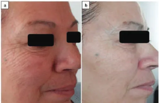 Fig. 1. Face photos of the same patient (63 years old), showing (a) face before laser irradiation and (b) after laser irradiation (7 sessions  lasting 30 min each).