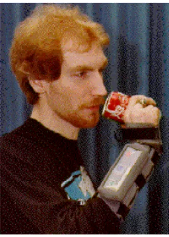 FIGURA 20: Órtese combinada com uso de FES – Bionic Glove.