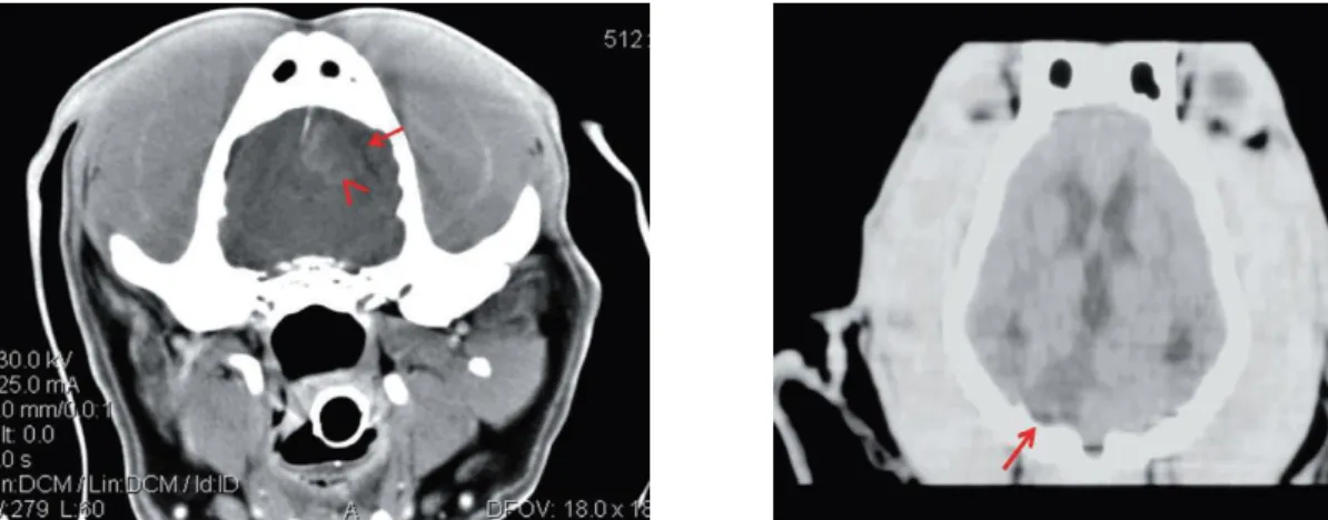 Figura 2 –Na imagem à esquerda observa-se no lobo frontal esquerdo uma área hiperdensa (cabeça da seta)  que causa efeito massa para a direita (AVC hemorrágico) e uma área hipodensa (seta) que rodeia a lesão  (edema)