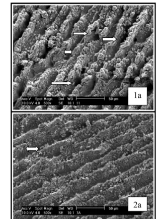 FIGURE 1 - 1a micrographic with disc 1 (lasers condition I) zoom 500X in SEM. Observe zones of melt and quick solidification that results linear defect with 25µm of thickness (double dart )