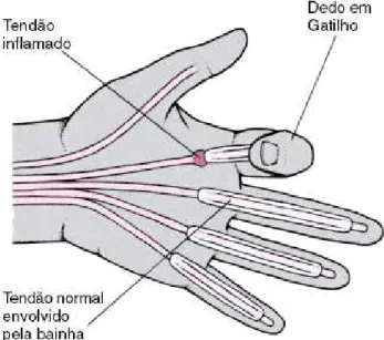 Figura 7. Imagem demonstrativa da patologia do dedo em gatilho (Sanches, 2011). 