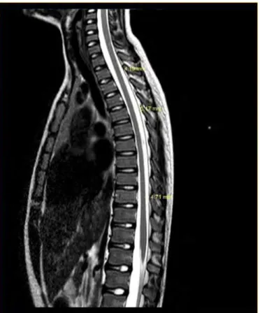 Figura 1 - Ressonância magnética de imagem da coluna vertebral e medula espinal nas  regiões cervical, torácica e lombar